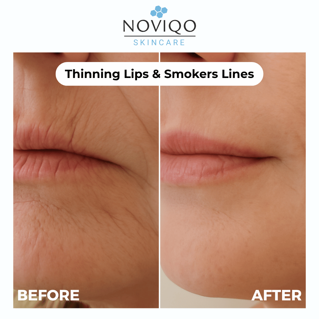 Noviqo™ – Anti-Wrinkle Nano-Silk Collagen Renewal System