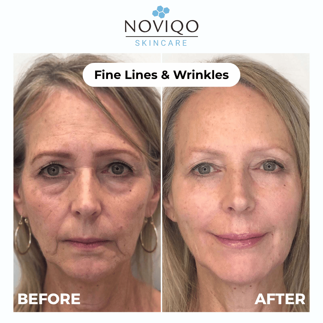 Noviqo™ – Anti-Wrinkle Nano-Silk Collagen Renewal System