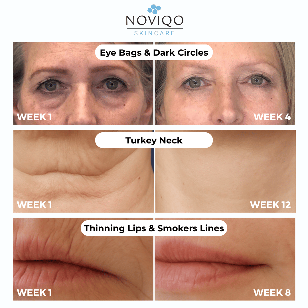Noviqo™ – Anti-Wrinkle Nano-Silk Collagen Renewal System