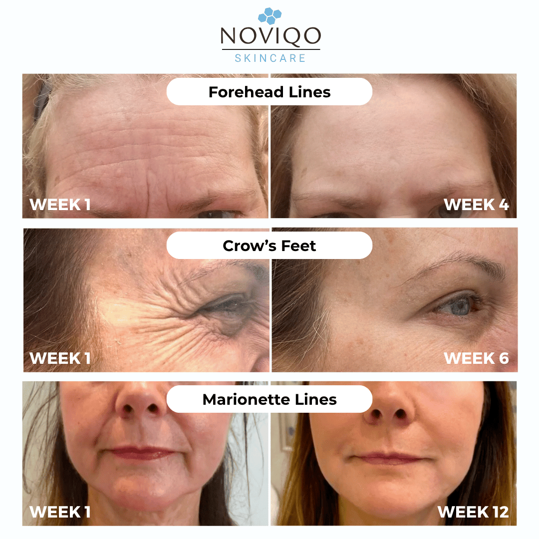 Noviqo™ – Anti-Wrinkle Nano-Silk Collagen Renewal System